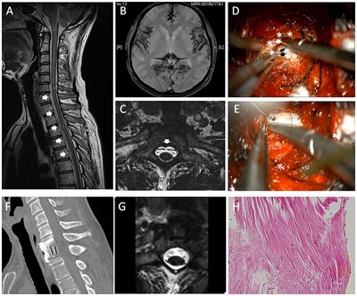 Case Report: Dural Dissection With Ventral Spinal Fluid-Filled Collection in Superficial Siderosis: Insights Into the Pathology From Anterior-Approached Surgical Cases